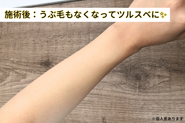 脱毛後の腕